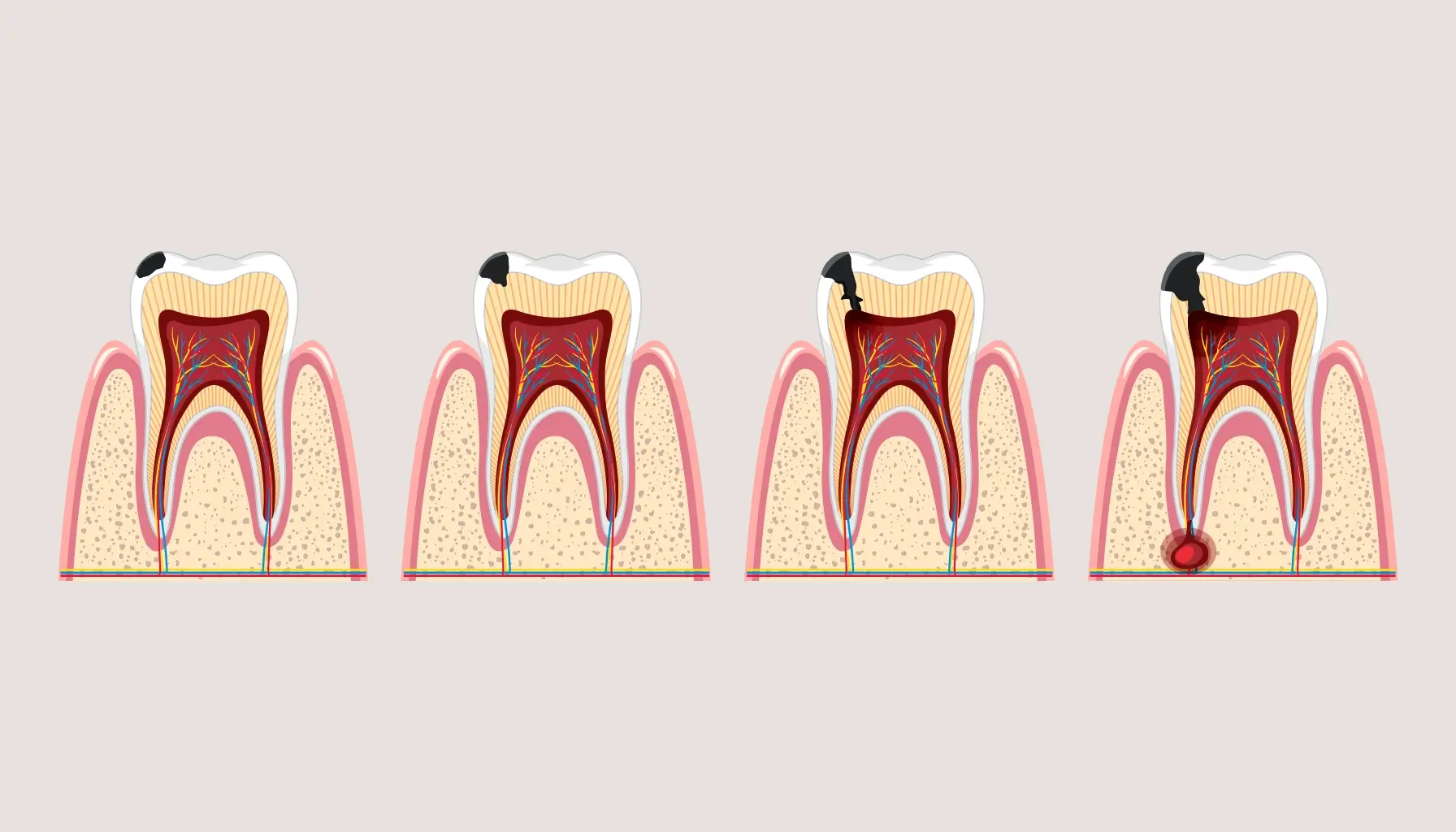 Caries Dentaires Les Signes R V Lateurs Et Sympt Mes Alarmants Dr