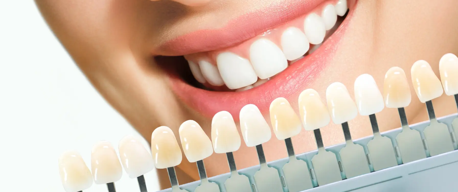 Jeune femme souriante. Facettes Cosmétologiques Dentaires en Porcelaine sur dr.parisescu.