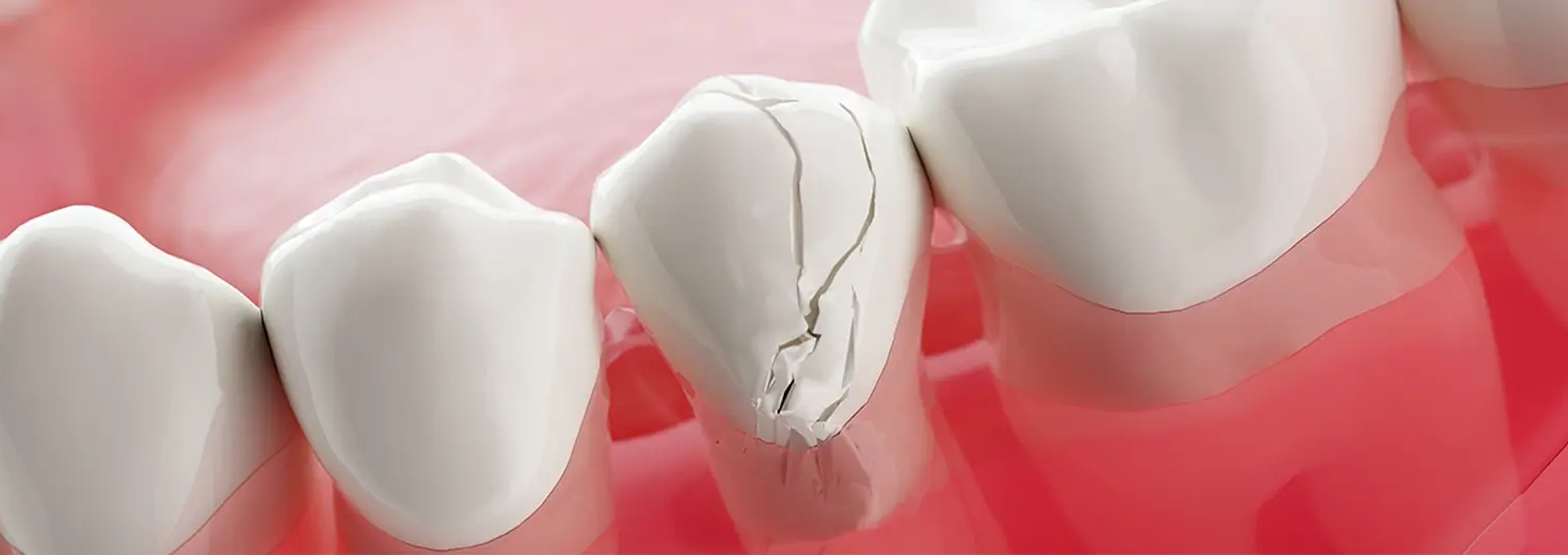 Dent ébréchée, Réparation des dents cassées ou fissurées