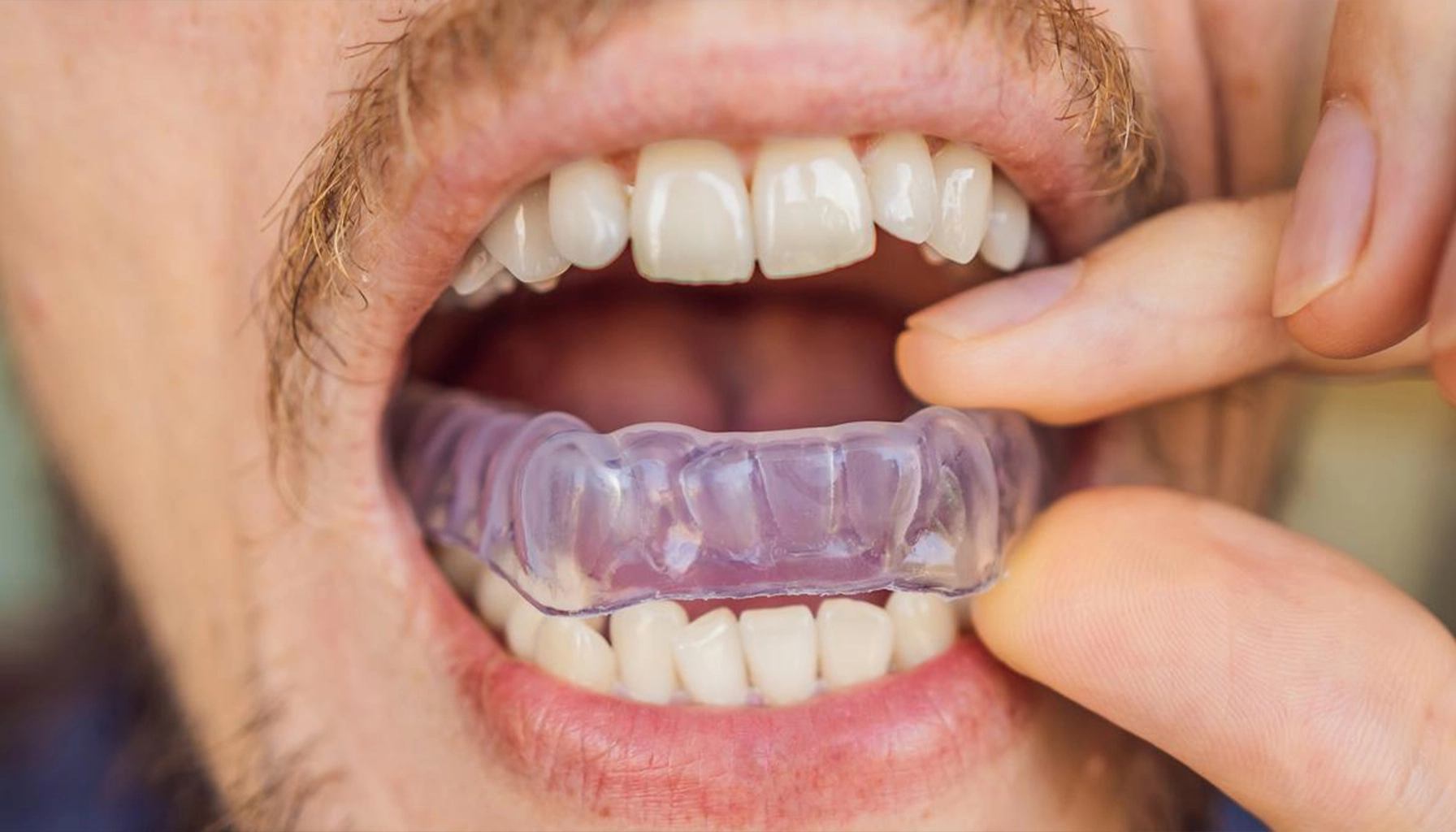 Homme plaçant une plaque à mordre dans sa bouche pour protéger ses dents la nuit du grincement causé par le bruxisme, vue rapprochée de sa main et de l'appareil