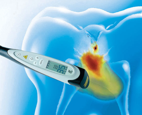 Un dentiste utilisant un appareil de fluorescence laser DIAGNOdent pour détecter les caries interproximales sur une dent d'un patient.