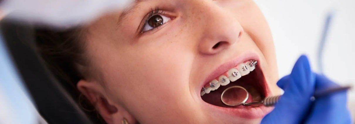 Fille avec des appareils orthodontiques, en cours d'un suivi dentaire régulier, pour corriger une asymétrie dentaire dans le cadre de son traitement orthodontique.