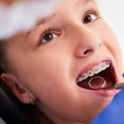 Fille avec des appareils orthodontiques, en cours d'un suivi dentaire régulier, pour corriger une asymétrie dentaire dans le cadre de son traitement orthodontique.