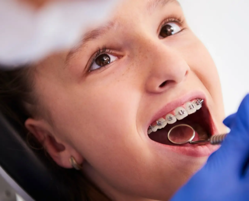 Fille avec des appareils orthodontiques, en cours d'un suivi dentaire régulier, pour corriger une asymétrie dentaire dans le cadre de son traitement orthodontique.