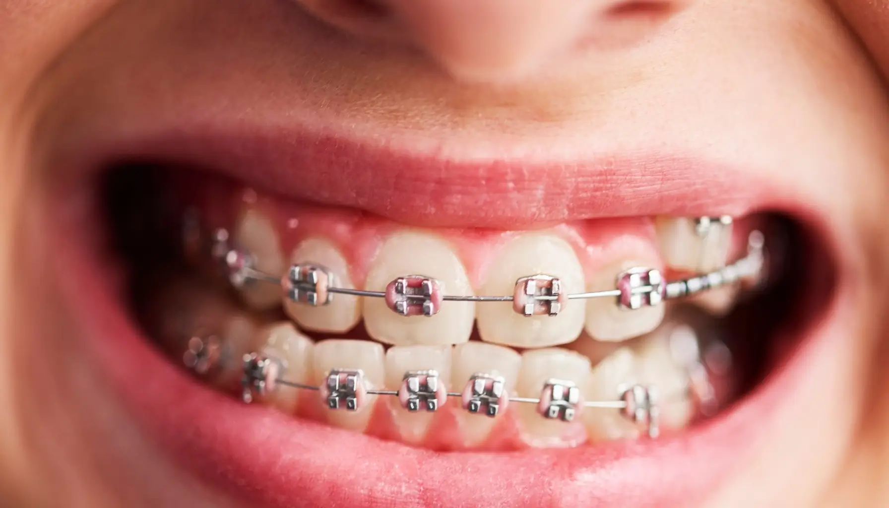 Image des dents d'un enfant avec des appareils orthodontiques, illustrant le traitement de l'asymétrie dentaire et l'hygiène bucco-dentaire. 