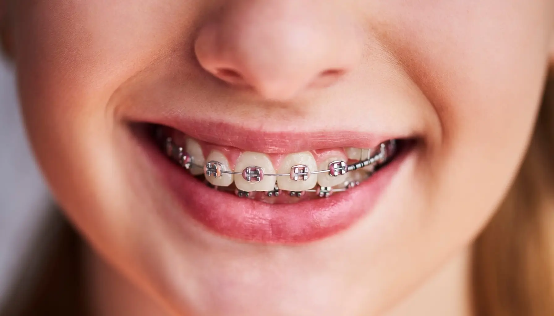 Gros plan de dents portant des appareils orthodontiques, montrant l'évolution du traitement orthodontique. 